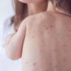 Fruthi në Kosovë: 25 raste të reja vetëm gjatë javës së fundit